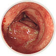 潰瘍性大腸炎
