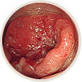 進行大腸癌