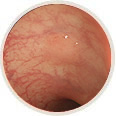 通常観察による大腸腺腫