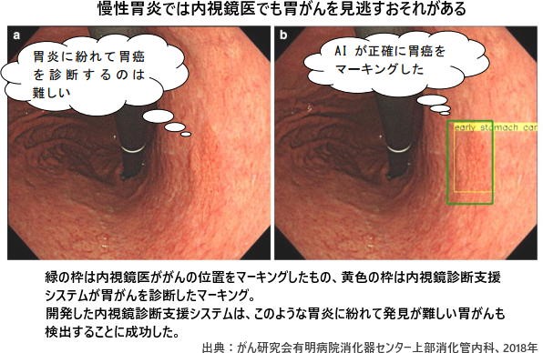 AIによる胃内視鏡の様子