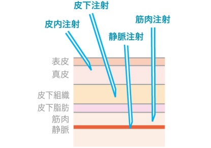 注射する層の図解